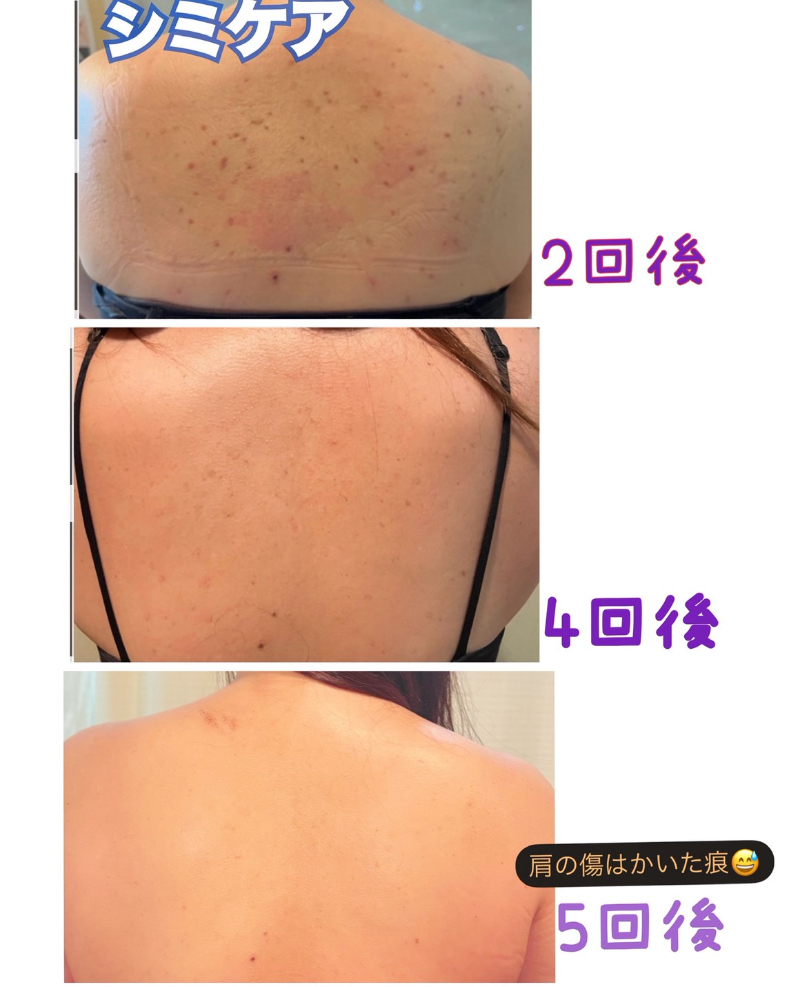 背中シミケア