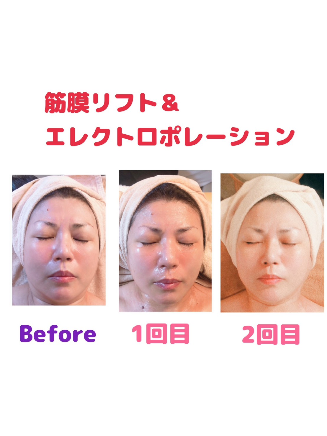 筋膜リフト＆エレクトロポレーション